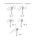 Transseptal closure of a patent foramen ovale and other cardiac defects diagram and image