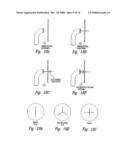 Transseptal closure of a patent foramen ovale and other cardiac defects diagram and image