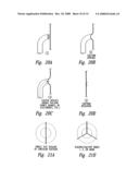 Transseptal closure of a patent foramen ovale and other cardiac defects diagram and image