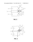 DEVICES AND METHODS FOR MEASURING THE SPACE AROUND A NERVE ROOT diagram and image