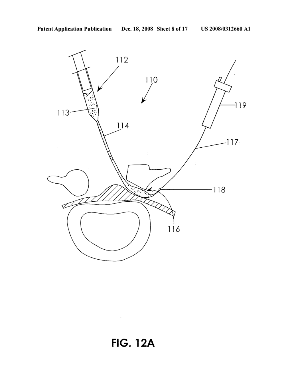 DEVICES AND METHODS FOR MEASURING THE SPACE AROUND A NERVE ROOT - diagram, schematic, and image 09