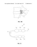 DEVICES AND METHODS FOR MEASURING THE SPACE AROUND A NERVE ROOT diagram and image