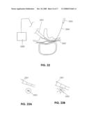 DEVICES AND METHODS FOR MEASURING THE SPACE AROUND A NERVE ROOT diagram and image