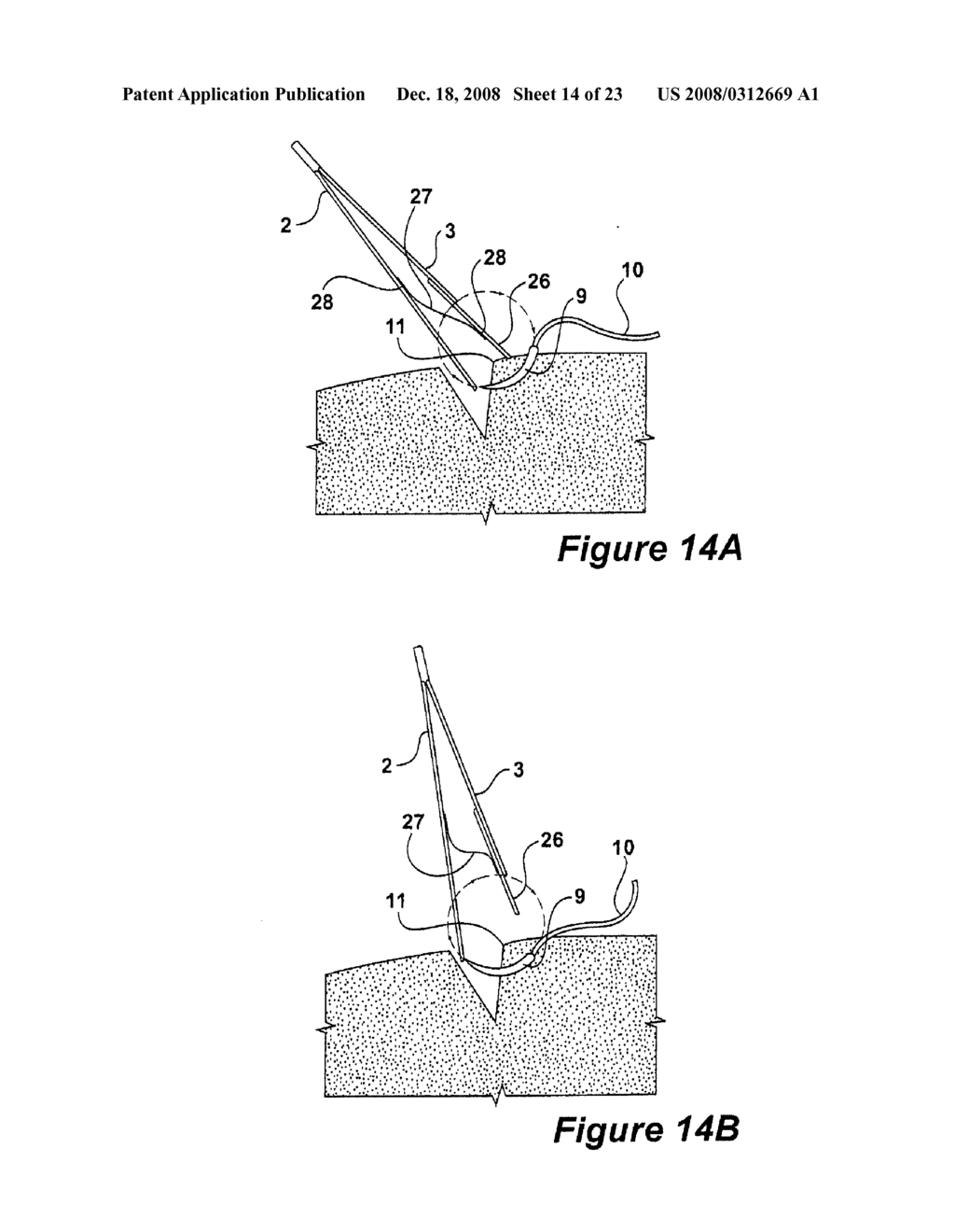 SURGICAL INSTRUMENT AND METHOD - diagram, schematic, and image 15