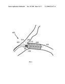 Method and apparatus for CTO crossing diagram and image