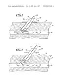 Apparatus and Method for Closing an Opening in a Blood Vessel Using Memory Metal and Collagen diagram and image