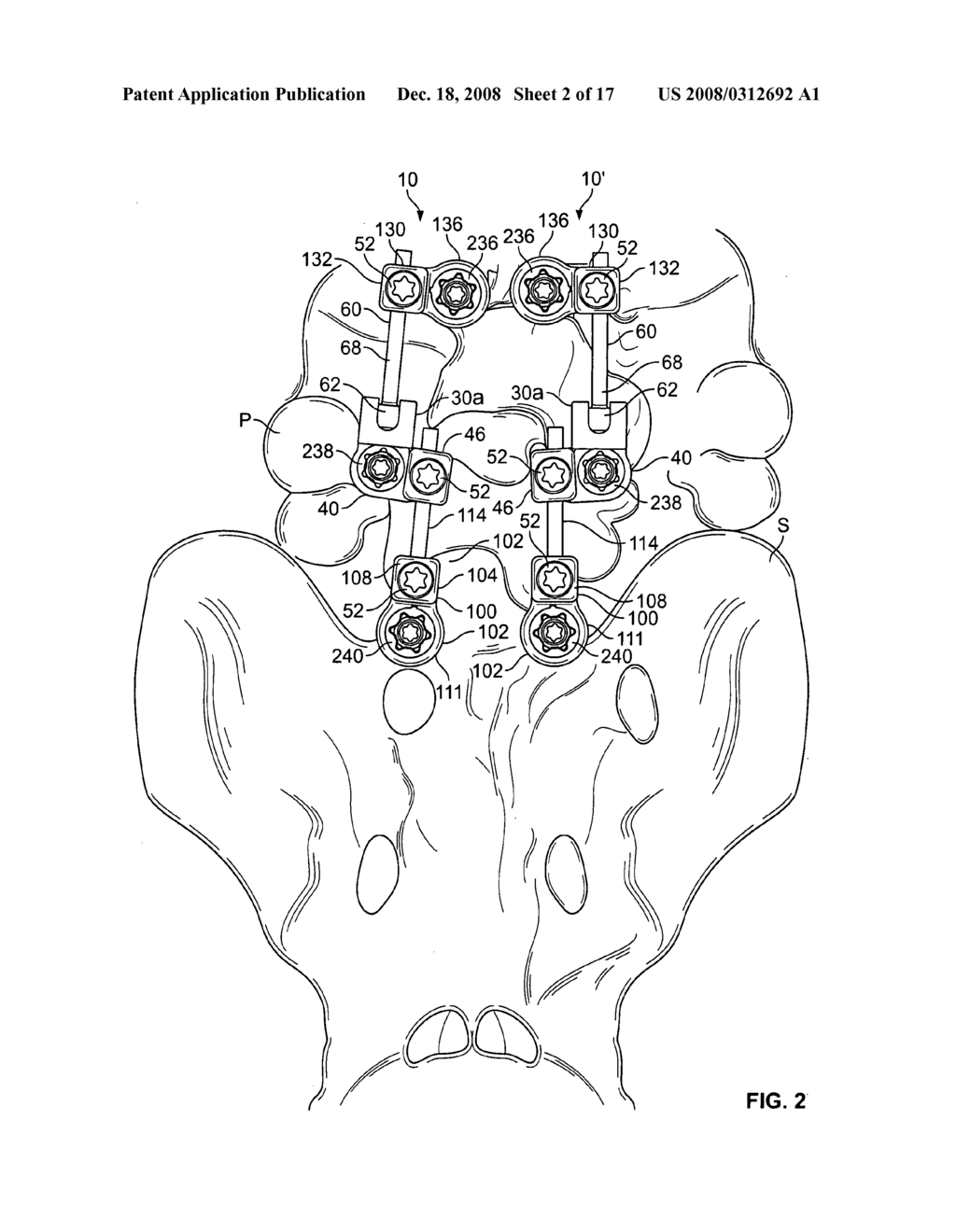 Multi-level spinal stabilization system - diagram, schematic, and image 03