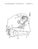 Hybrid Cochlear Implant diagram and image