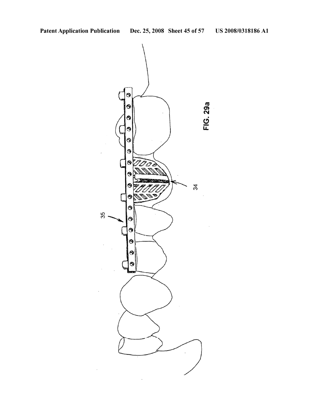 DENTAL DEVICE, SUCH AS A BRIDGE OR INSERT - diagram, schematic, and image 46