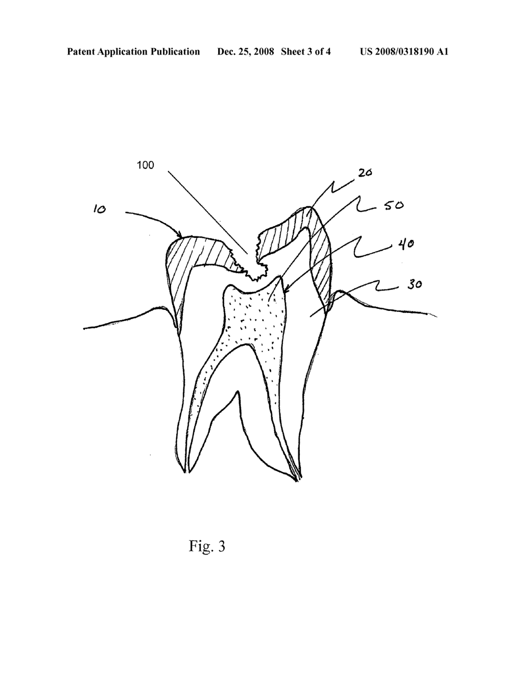Polymerizable Dental Pulp Healing, Capping, and Lining Material and Method for Use - diagram, schematic, and image 04