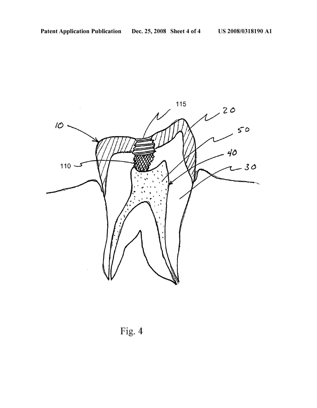 Polymerizable Dental Pulp Healing, Capping, and Lining Material and Method for Use - diagram, schematic, and image 05