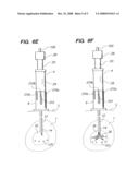 PERCUTANEOUS ARRAY DELIVERY SYSTEM diagram and image