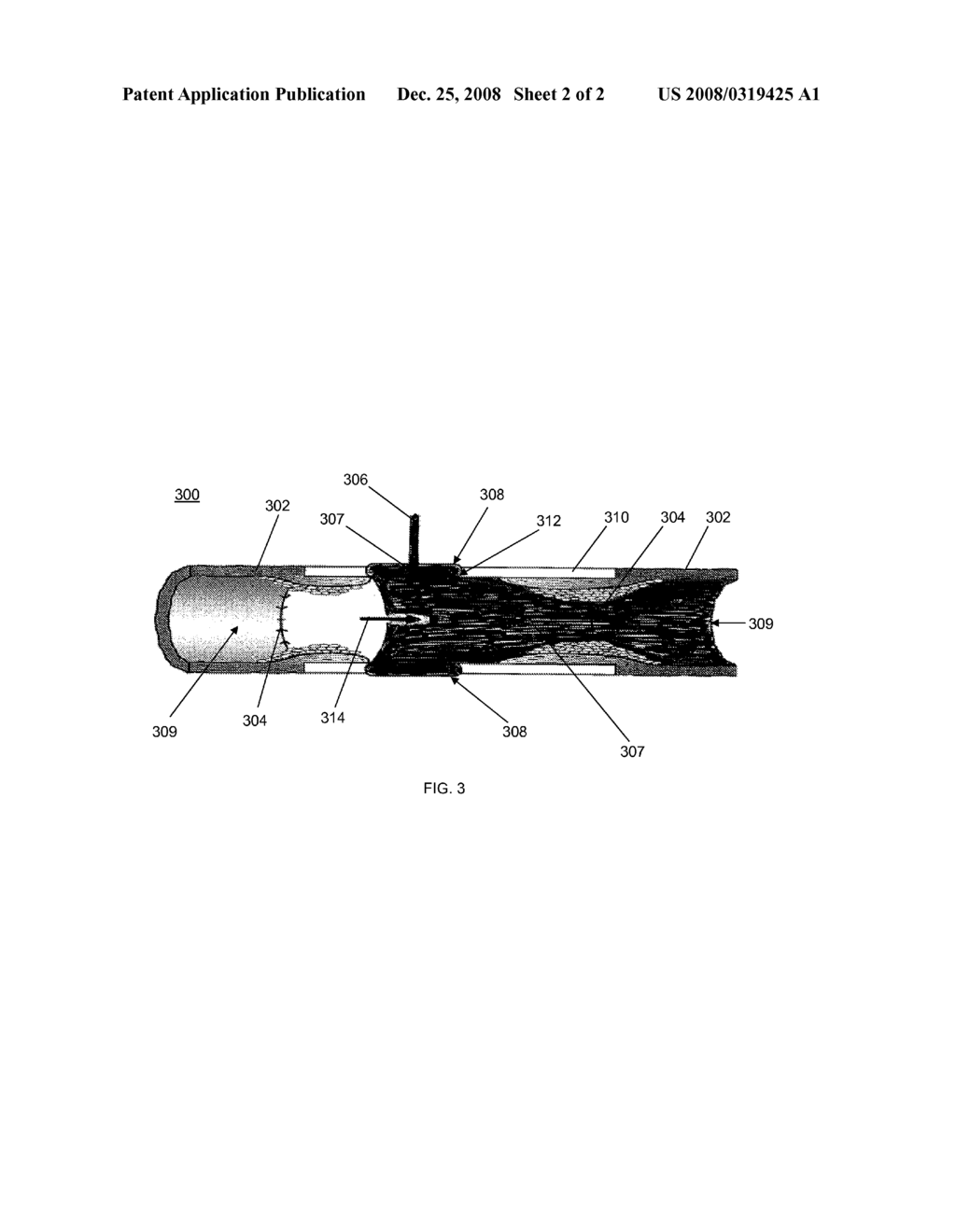 DRUG-ELUTING GRAFT - diagram, schematic, and image 03