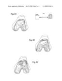 SYSTEM AND METHOD FOR DETERMINING AN OPTIMAL TYPE AND POSITION OF AN IMPLANT diagram and image