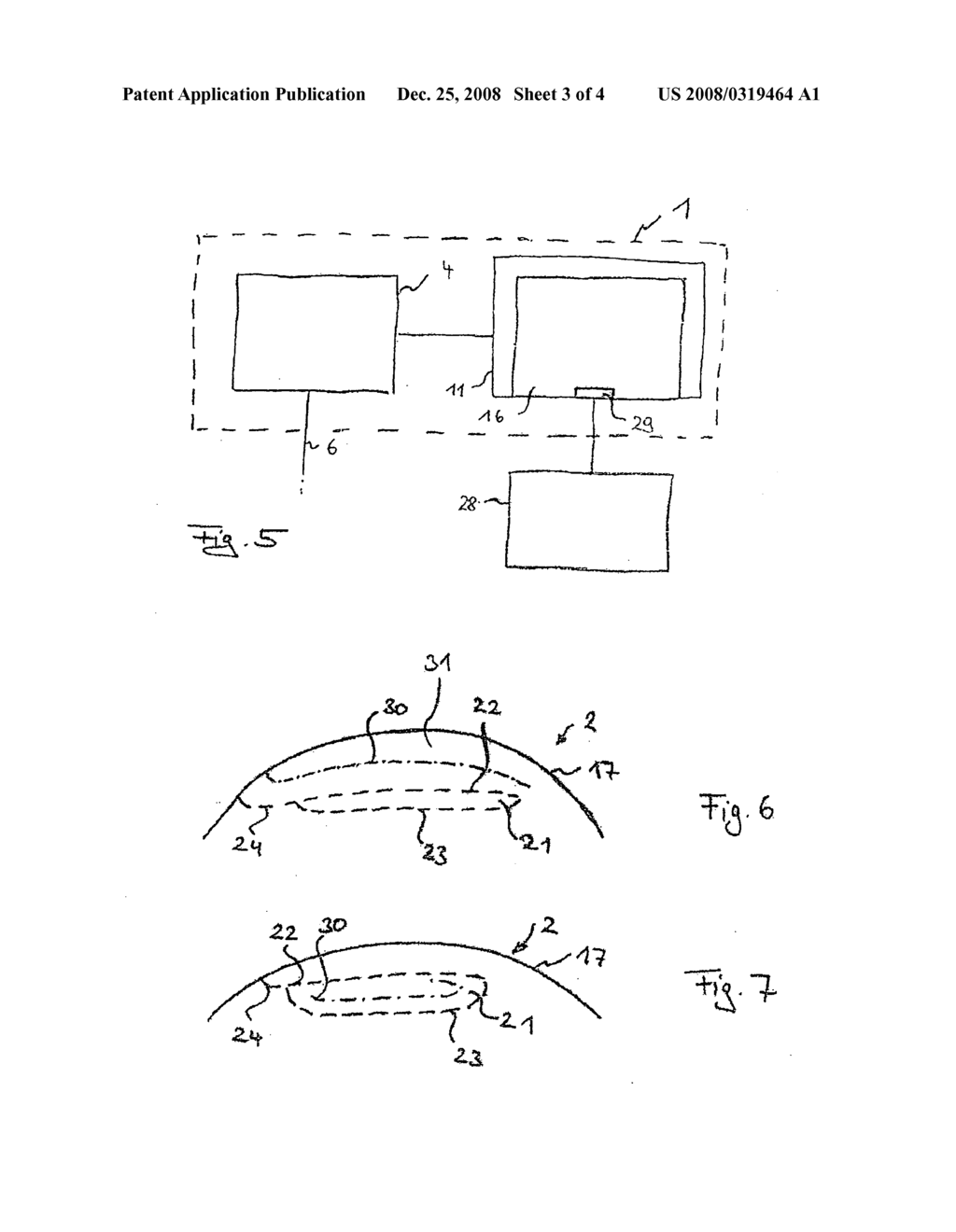 RE-TREATMENT FOR OPHTHALMIC CORRECTION OF REFRACTION - diagram, schematic, and image 04