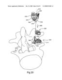 SYSTEM AND METHOD FOR FACET JOINT REPLACEMENT WITH DETACHABLE COUPLER diagram and image