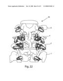 SYSTEM AND METHOD FOR FACET JOINT REPLACEMENT WITH DETACHABLE COUPLER diagram and image