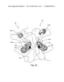 SYSTEM AND METHOD FOR FACET JOINT REPLACEMENT WITH DETACHABLE COUPLER diagram and image