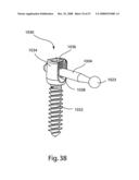 SYSTEM AND METHOD FOR FACET JOINT REPLACEMENT WITH DETACHABLE COUPLER diagram and image