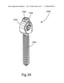 SYSTEM AND METHOD FOR FACET JOINT REPLACEMENT WITH DETACHABLE COUPLER diagram and image