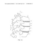 Methods and Devices for Controlled Flexion Restriction of Spinal Segments diagram and image