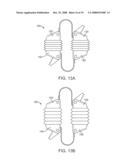 Methods and Devices for Controlled Flexion Restriction of Spinal Segments diagram and image