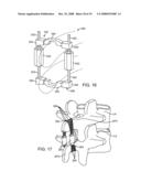 Methods and Devices for Controlled Flexion Restriction of Spinal Segments diagram and image