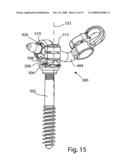 SYSTEM AND METHOD FOR FACET JOINT REPLACEMENT diagram and image