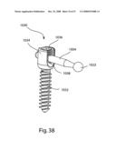 SYSTEM AND METHOD FOR FACET JOINT REPLACEMENT diagram and image