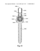 SYSTEM AND METHOD FOR FACET JOINT REPLACEMENT diagram and image