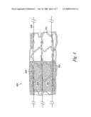 Percutaneous valve, system and method diagram and image