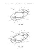  W  Accommodating Intraocular Lens diagram and image