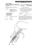 SHEATHS FOR IMPLANTABLE FIXATION DEVICES diagram and image