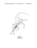 SHEATHS FOR IMPLANTABLE FIXATION DEVICES diagram and image