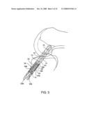 SHEATHS FOR IMPLANTABLE FIXATION DEVICES diagram and image