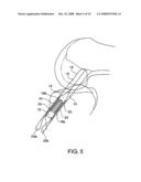 SHEATHS FOR IMPLANTABLE FIXATION DEVICES diagram and image