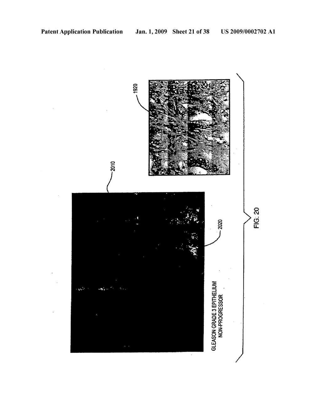 DISTINGUISHING BETWEEN RENAL ONCOCYTOMA AND CHROMOPHOBE RENAL CELL CARCINOMA USING RAMAN MOLECULAR IMAGING - diagram, schematic, and image 22