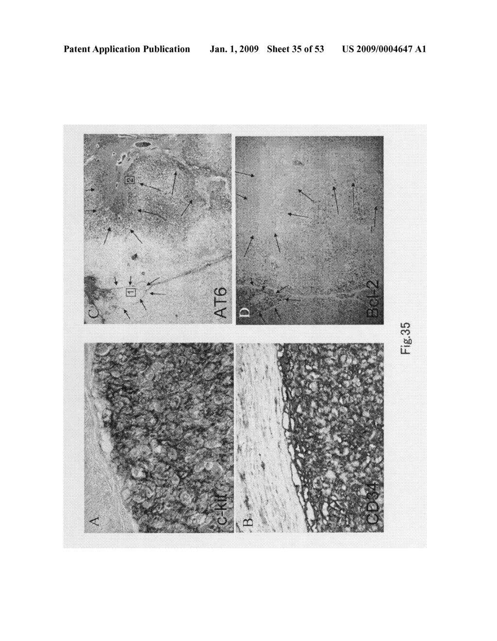 Method of Judging Grade of Malignancy of Carcinoma Cell - diagram, schematic, and image 36