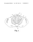 Multi-Leveled Transgluteal Tension-Free Levatorplasty For Treatment of Rectocele diagram and image