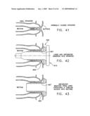 Rotate-to- advance catheterization system diagram and image