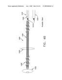 Rotate-to- advance catheterization system diagram and image