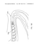 Rotate-to- advance catheterization system diagram and image