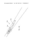 Rotate-to- advance catheterization system diagram and image