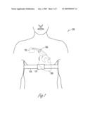 DETECTION OF CONGESTION FROM MONITORING PATIENT RESPONSE TO A RECUMBENT POSITION diagram and image