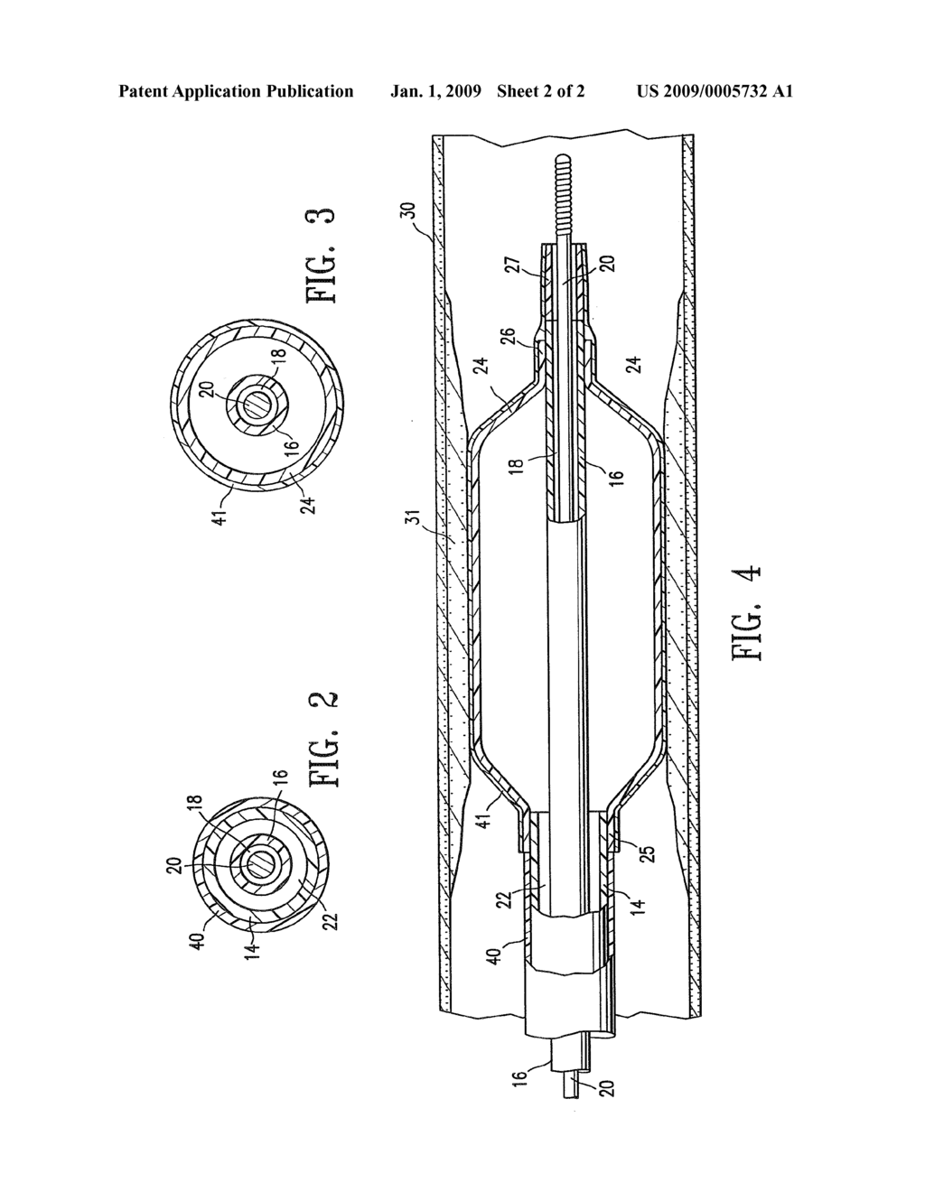 REDUCED SLIPPAGE BALLOON CATHETER AND METHOD OF USING SAME - diagram, schematic, and image 03