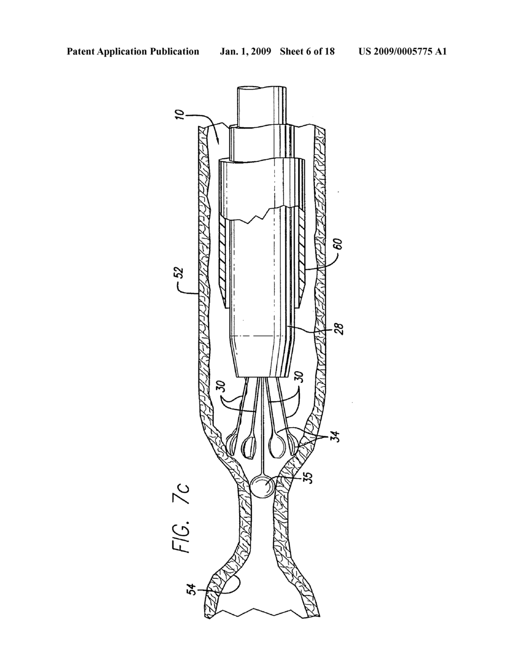 EXPANDABLE CATHETER HAVING TWO SETS OF ELECTRODES - diagram, schematic, and image 07