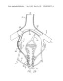 EXPANDABLE CATHETER HAVING TWO SETS OF ELECTRODES diagram and image