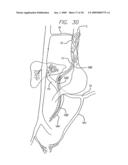 EXPANDABLE CATHETER HAVING TWO SETS OF ELECTRODES diagram and image