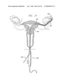 EXPANDABLE CATHETER HAVING TWO SETS OF ELECTRODES diagram and image