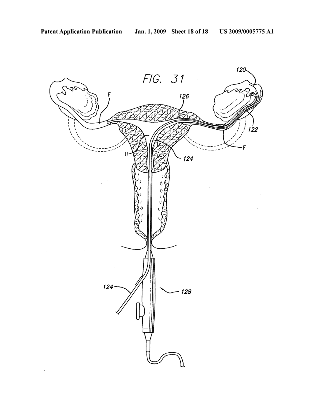 EXPANDABLE CATHETER HAVING TWO SETS OF ELECTRODES - diagram, schematic, and image 19